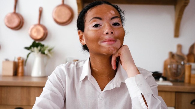 Apakah Vitiligo Bisa Diobati? Ini Penjelasan Dokter Spesialis Kulit