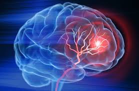 Jangan Berlebihan Minum Alkohol Bila tak Ingin Kena Stroke Secara Mendadak!