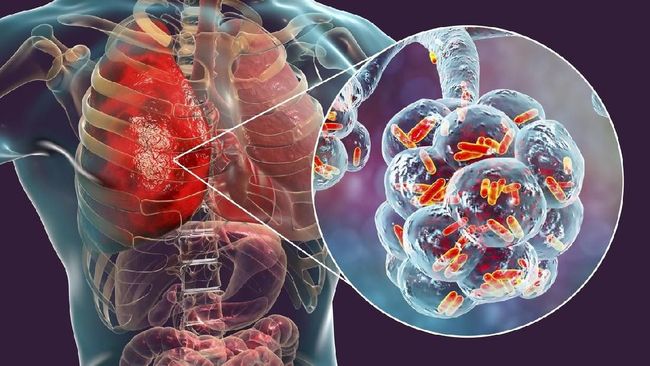 Apa Itu Pneumonia Bilateral, Penyakit yang Diidap Paus Fransiskus Sebelum Meninggal?